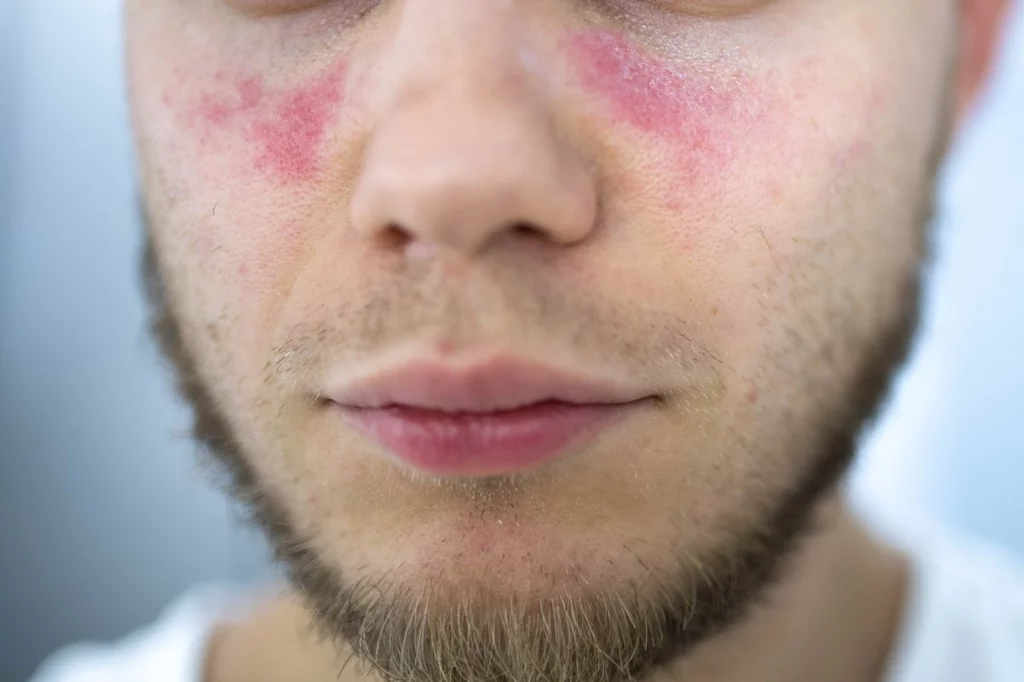 La SEFH ha publicado la 'Gua de Práctica Farmacéutica en Lupus Eritematoso Sistémico'.