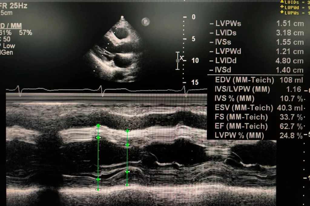 Ecocardiograma que muestra la FEVI. Foto: SHUTTERSTOCK