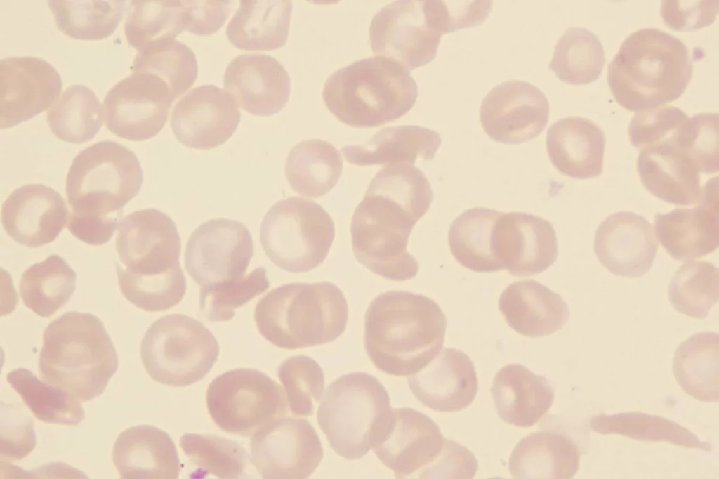 La anemia falciforme es una enfermedad rara en España, pero es uno de los trastornos hereditarios de la sangre más frecuentes en el mundo. Foto: SHUTTERSTOCK