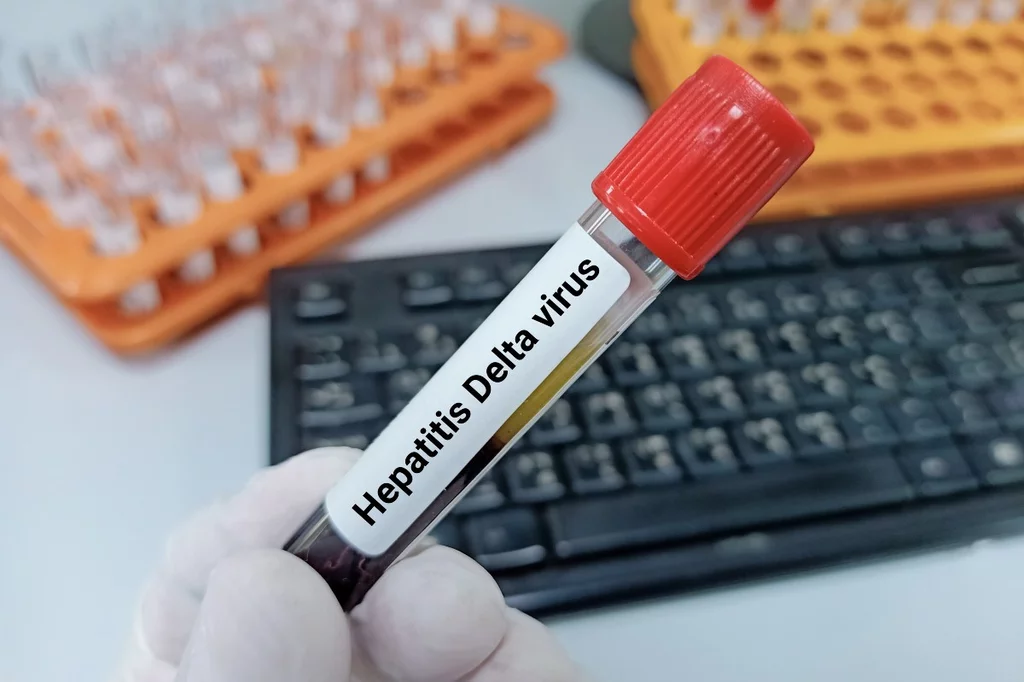 La infección de VHD afecta aproximadamente al 5% de las personas con hepatitis B, con una prevalencia global de más de 12 millones de personas.