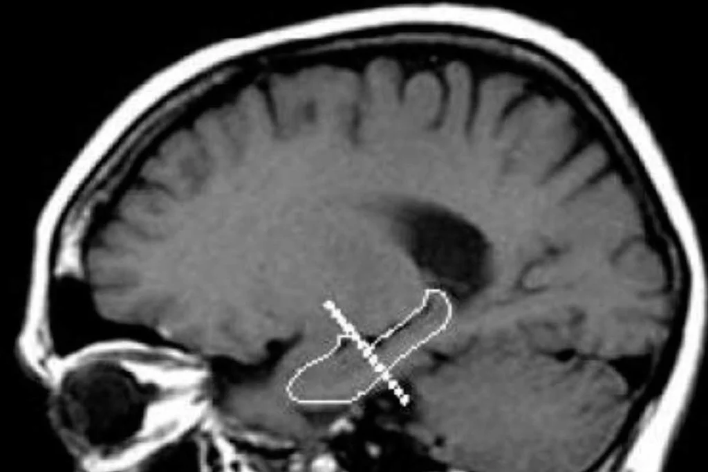 La UAB ha estudio los efectos podría tener una dieta de restricción calórica sobre el hipocampo del cerebro humano.