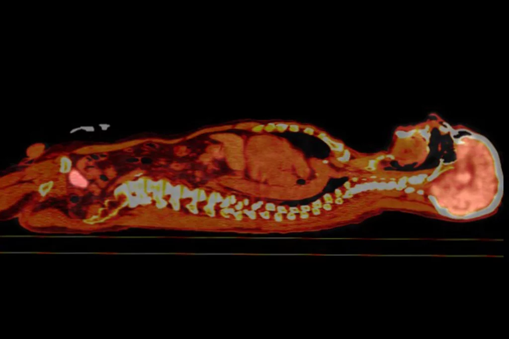 Tomografía de emisión de positrones (PET). Foto: SHUTTERSTOCK .