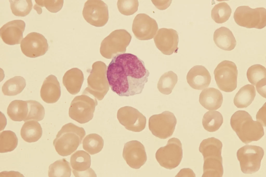 La leucemia linfocÃtica crÃ³nica es la mÃ¡s frecuente en los paÃses occidentales. Foto: SHUTTERSTOCK.