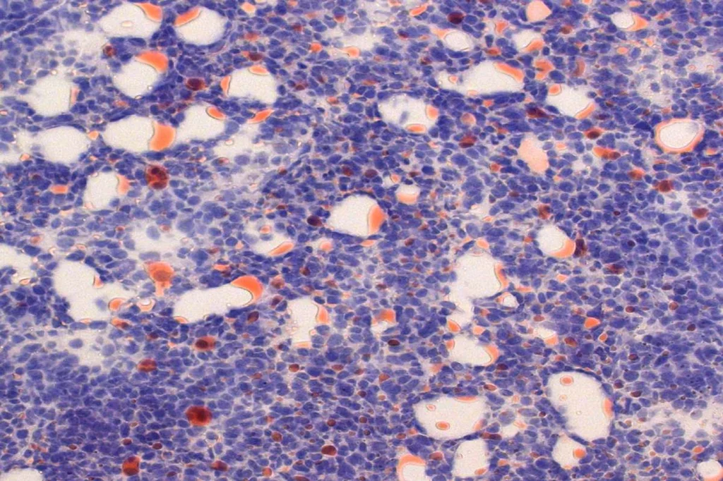 La ferroptosis, proceso asociado a la dieta cetogÃ©nica, mata a las cÃ©lulas tumorales (en blanco) con una acumulaciÃ³n letal de molÃ©culas grasas tÃ³xicas (en rojo). Foto: CSHL