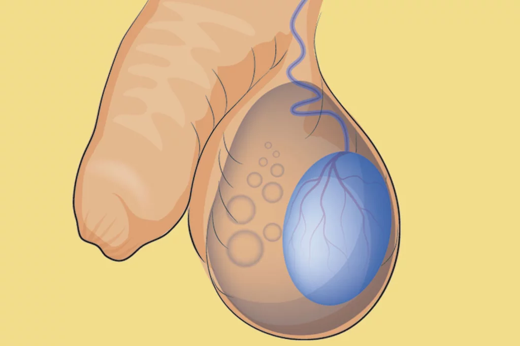 El hidrocele consiste en una acumulaciÃ³n de lÃquido circunscrita a la cavidad vaginal del testÃculo.