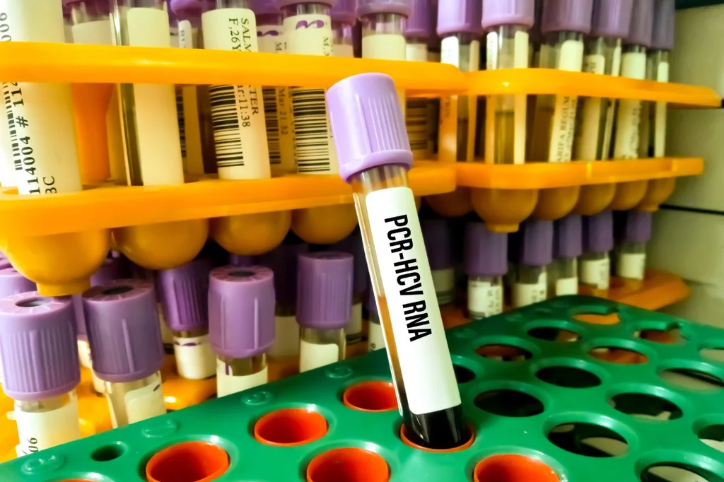 Análisis de muestras de sangre para detectar la infección por el virus de la hepatitis C. Foto: SHUTTERSTOCK..