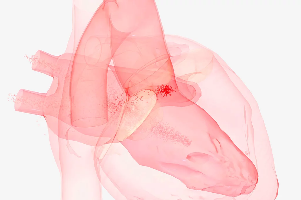 Con la fibrilación auricular, la sangre puede quedar atrapada en el pequeño apéndice auricular izquierdo y formar un coágulo, como en esta representación 3D. Foto: SHUTTERSTOCK.