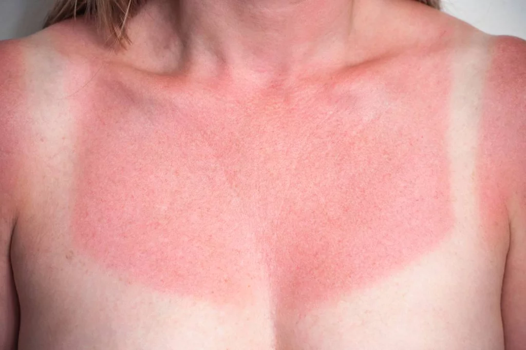 La exposiciÃ³n solar descontrolada y en exceso es lo mÃ¡s agresivo para la piel. Foto: CF.