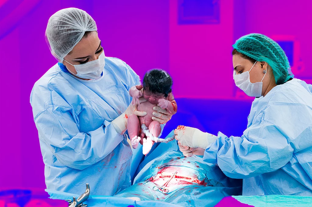 En la imagen, el nacimiento de un niño mediante la cesárea de la madre. FOTO: DM