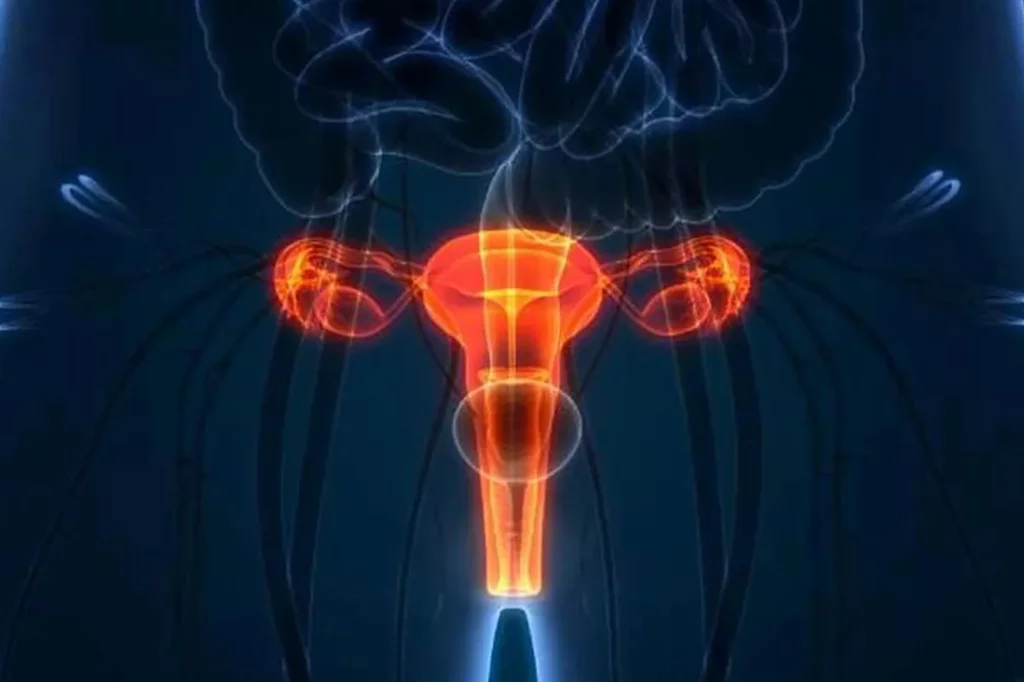La formación de tejido cicatricial dentro del útero es la principal característica del Asherman. Foto. DM. 