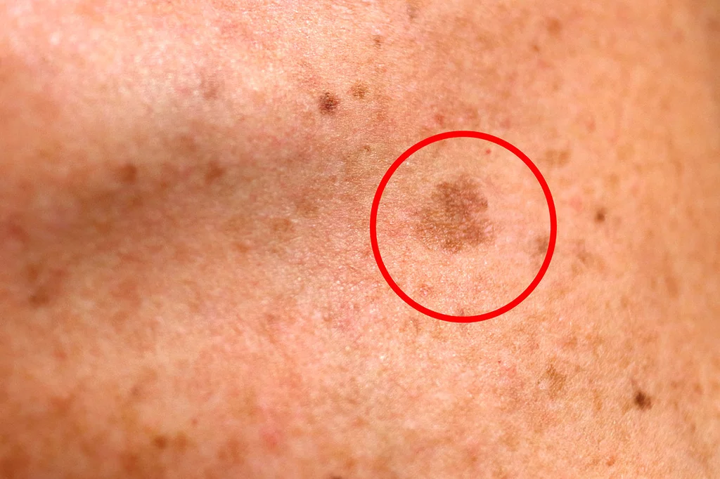 Siempre se deberá derivar al médico cuando se sospeche una queratosis actínica o un cáncer de piel. Foto: SHUTTERSTOCK.