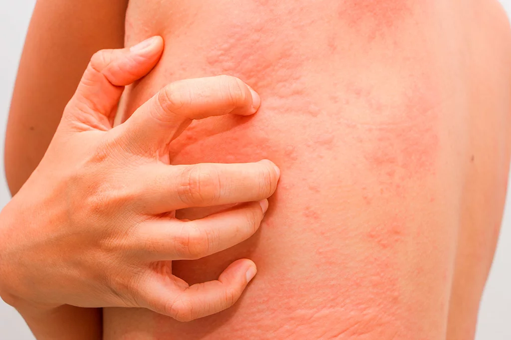 La urticaria crónica es una patología inflamatoria que presenta ronchas pruriginosas con o sin angioedema y con una frecuencia casi diaria durante, al menos, 6 semanas. Foto: SHUTTERSTOCK