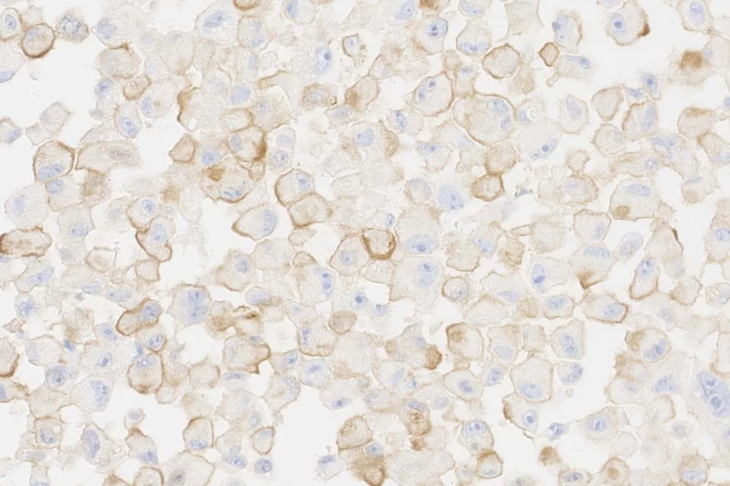 Células tumorales senescentes de melanoma humano. En marrón, la proteína PD-L2 que actúa de escudo protector y evita la acción del sistema inmune. Foto: IRB BARCELONA