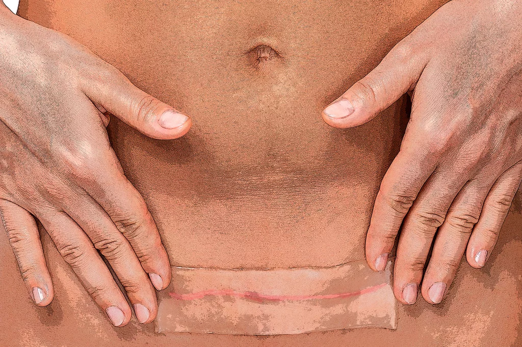 Imagen de la cicatriz tras una cesárea. Foto tratada por LOURDES ESPARZA