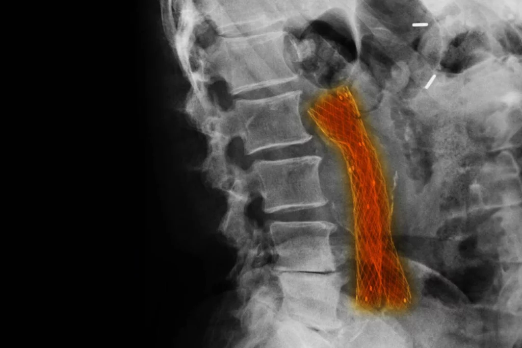Imagen de rayos X que muestra un 'stent' en una arteria ilíaca para el tratamiento de la enfermedad vascular aterosclerótica. Foto: AGEFOTOSTOCK