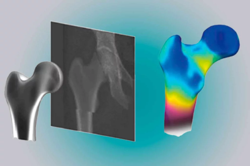 La nueva metodología (3D-DXA) permite obtener imágenes 3D del fémur y así mejorar la predicción del riesgo de fractura del hueso. Imagen: UPF.