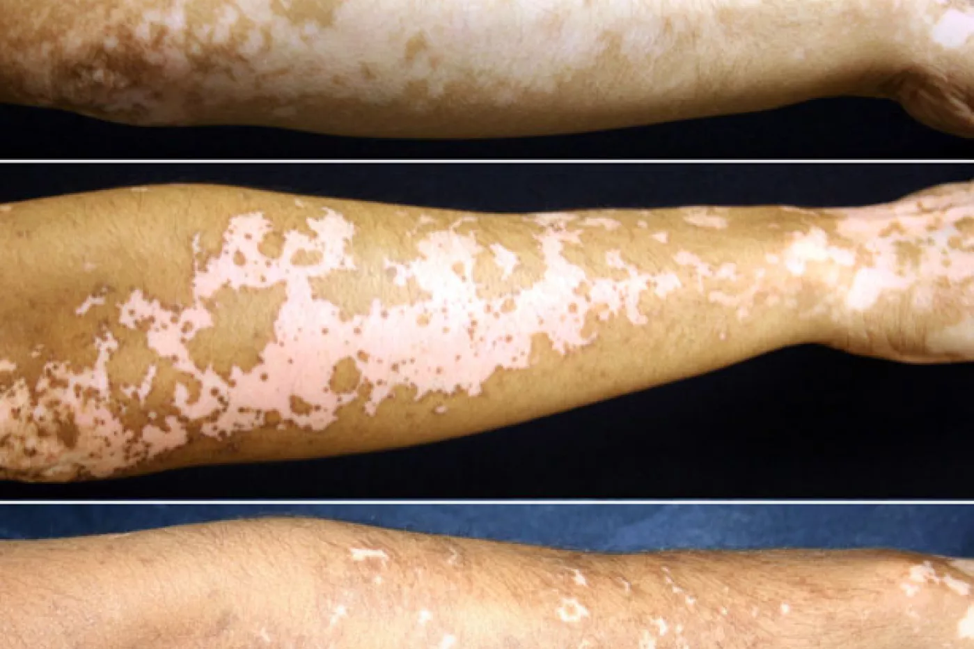 Un tratamiento para el vitíligo podría la pigmentación la piel |