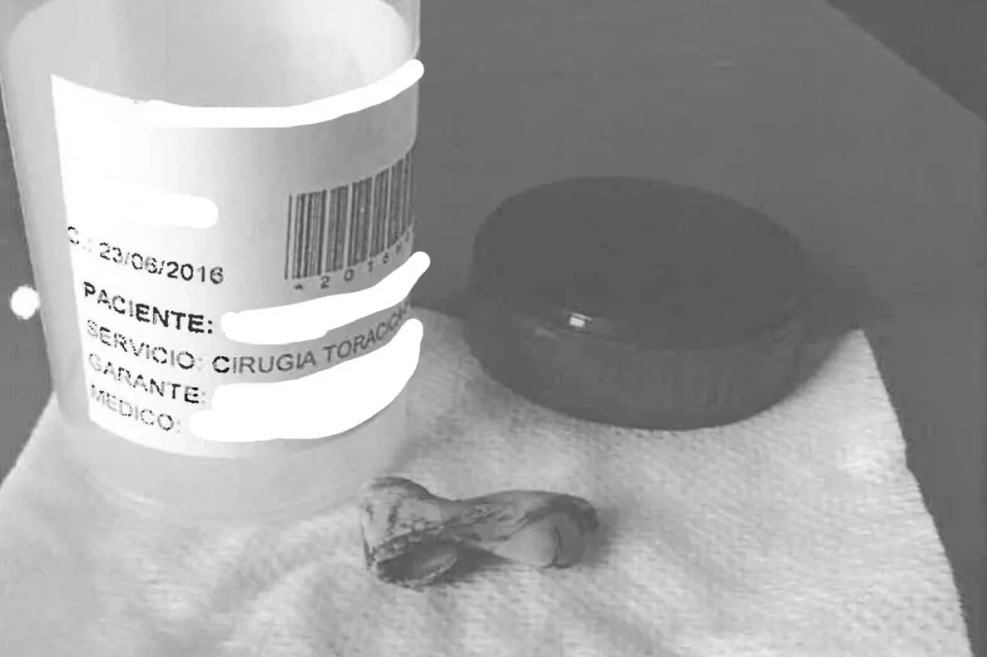 Pieza de cemento de 3 centímetros extraída del cuerpo de la paciente. 