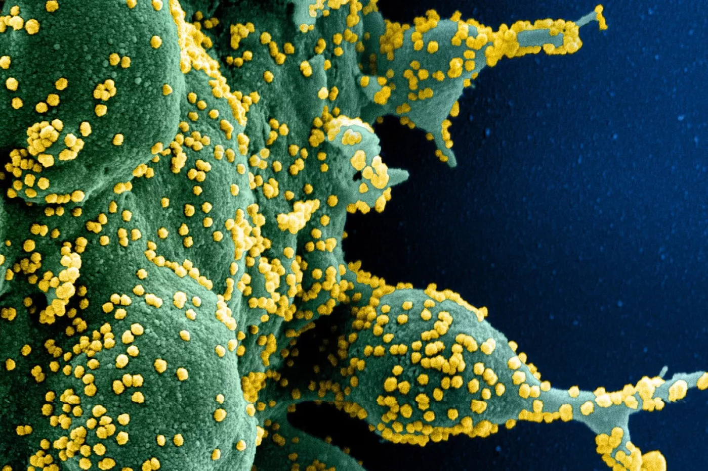 Micrografía electrónica de barrido coloreada de una célula apoptótica (verde) muy infectada con partículas del virus SARS-COV-2 (amarillo), aislada de una muestra de paciente.