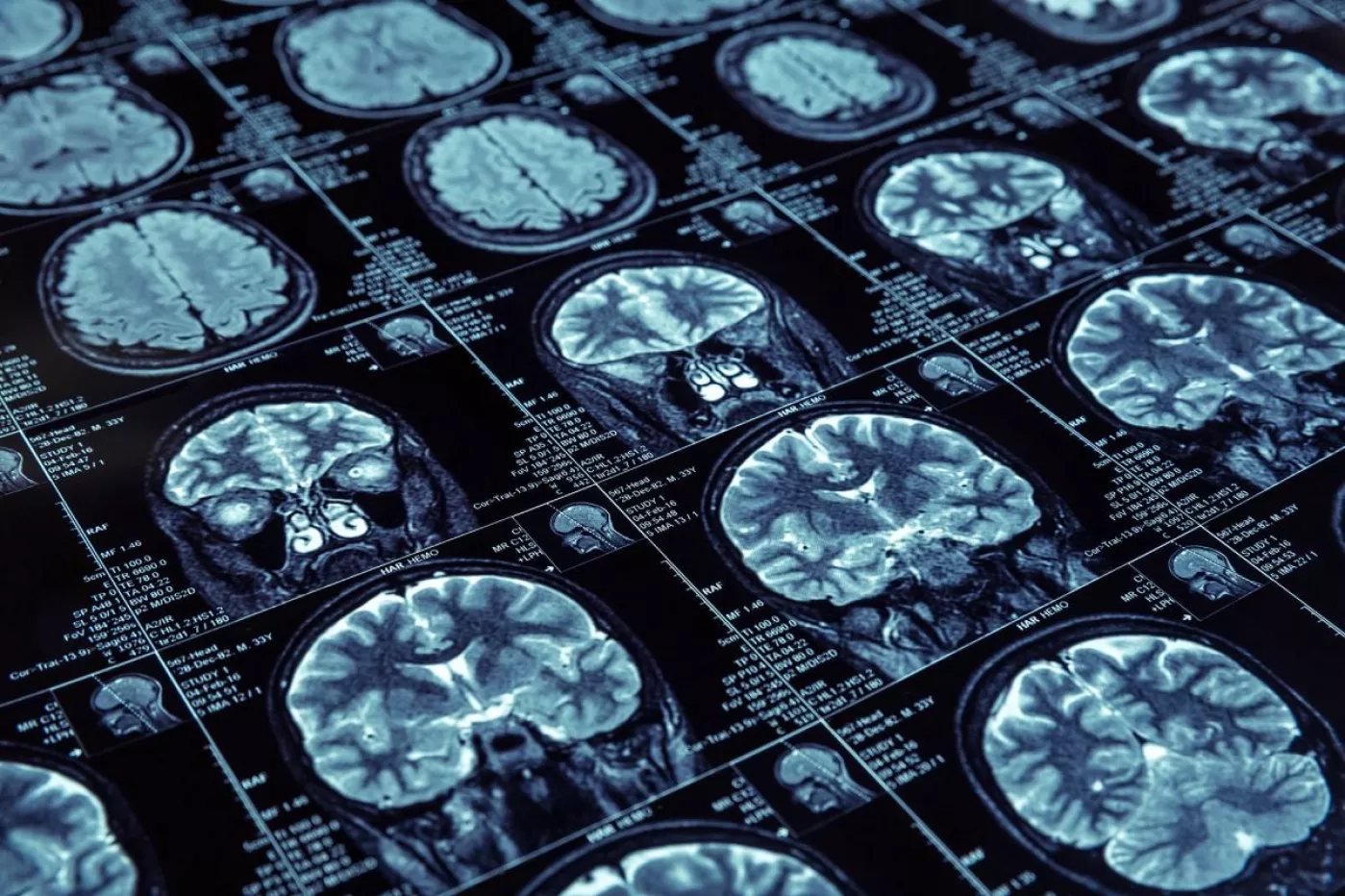 Estudios de imagen que muestran enfermedad de Alzheimer. 