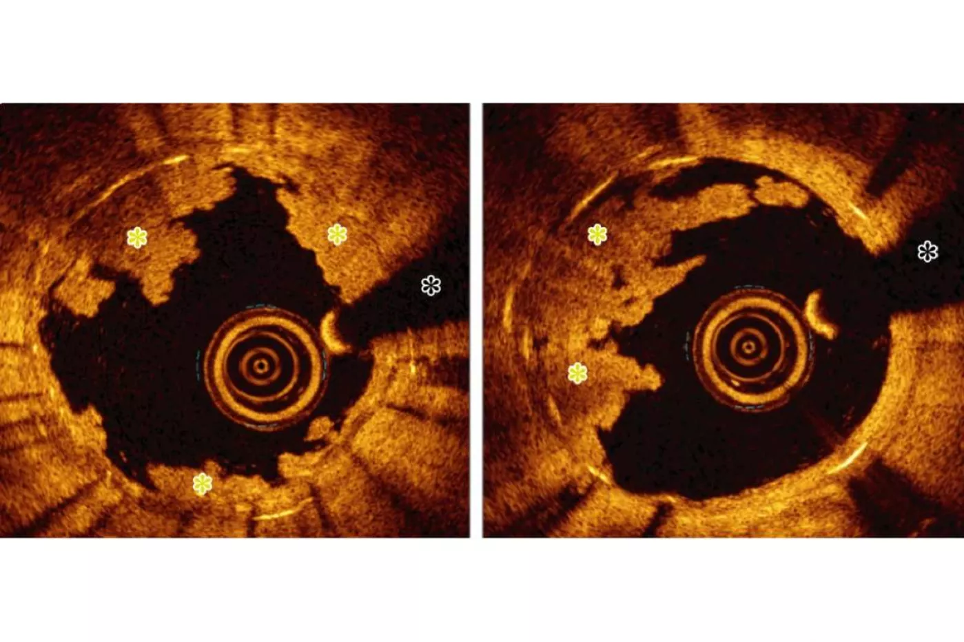 Tomografia por coherencia óptica (OTC) que muestra la trombosis del stent.
