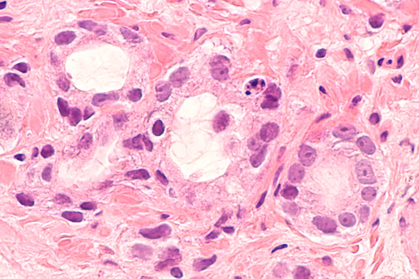 Células de cáncer de próstata.