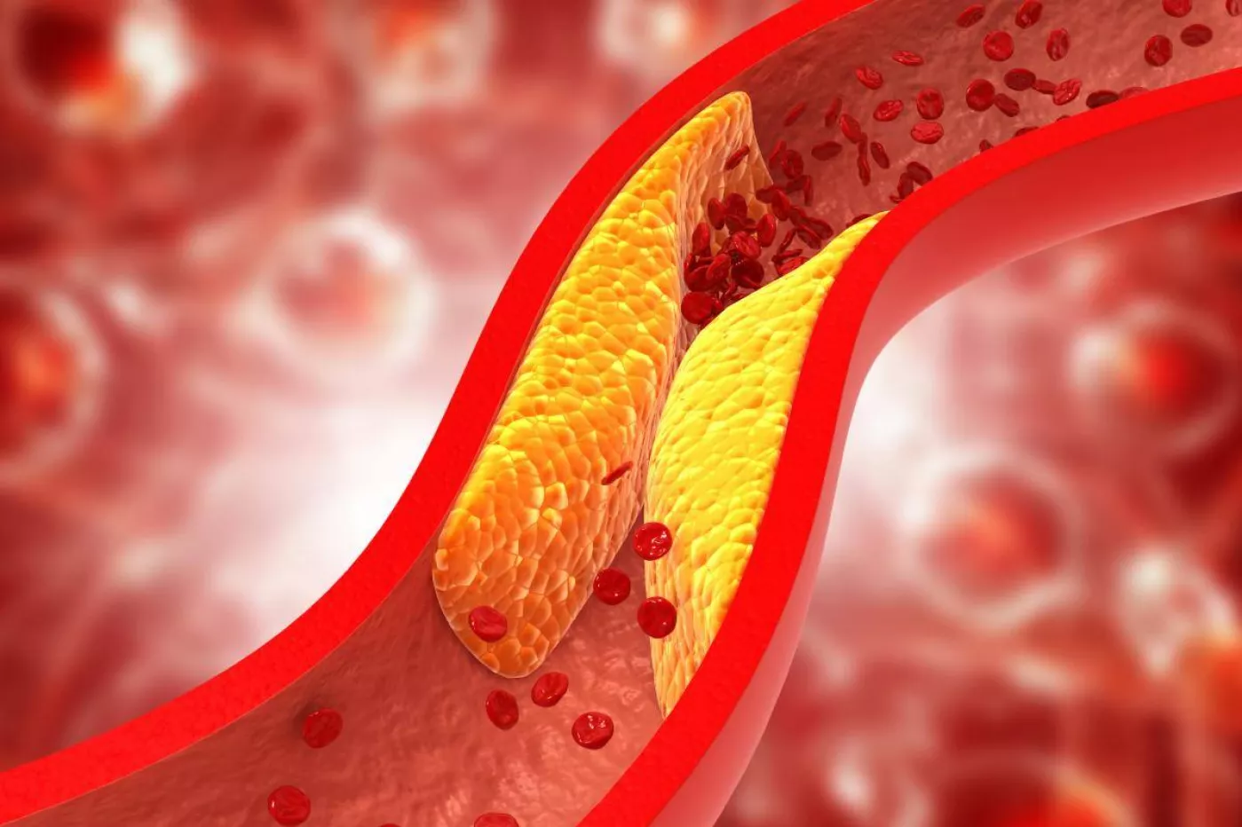 El colesterol es uno de los principales factores de riesgo cardiovascular modificables. 