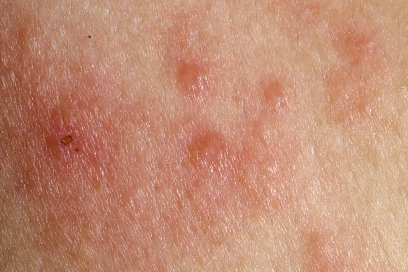 Piel afectada por dermatitis atópica.