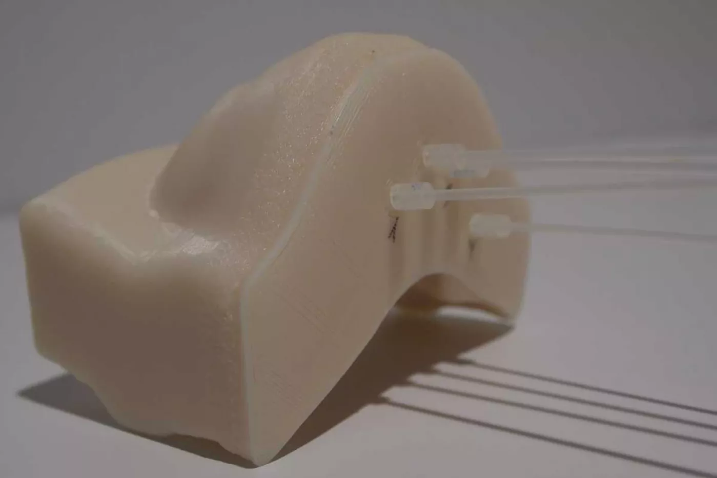 Los moldes para plesioterapia en cáncer de piel se pueden realizar con impresora 3D. Foto: Hospital del Mar