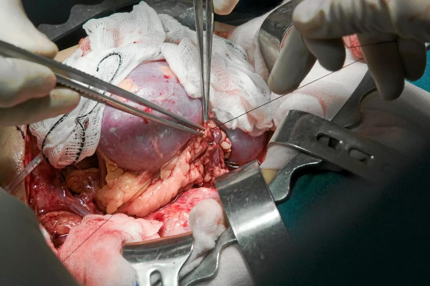 Momento en el que se injerta un riñón durante un trasplante.
