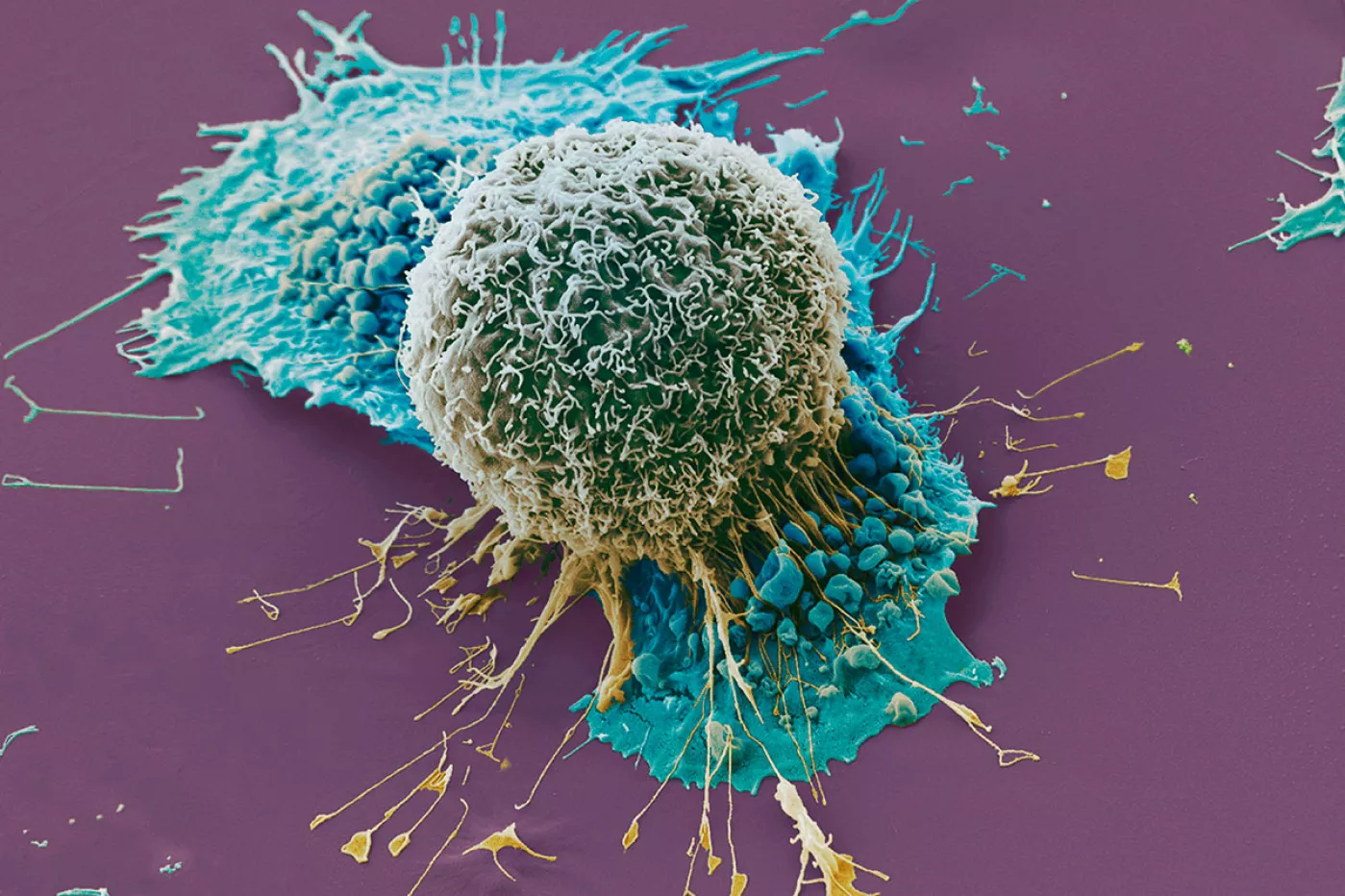 La detección de mutaciones en células de cáncer de pulmón permite asentar la medicina de precisión. Foto: DM. 