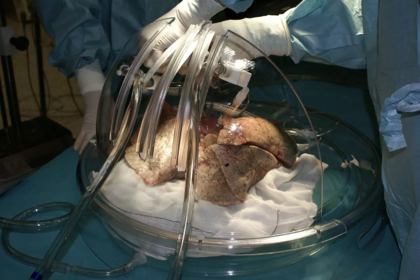 Introducción de los pulmones en una caja estéril para un trasplante bipulmonar. Foto: MAURICIO SKRYCKY.
