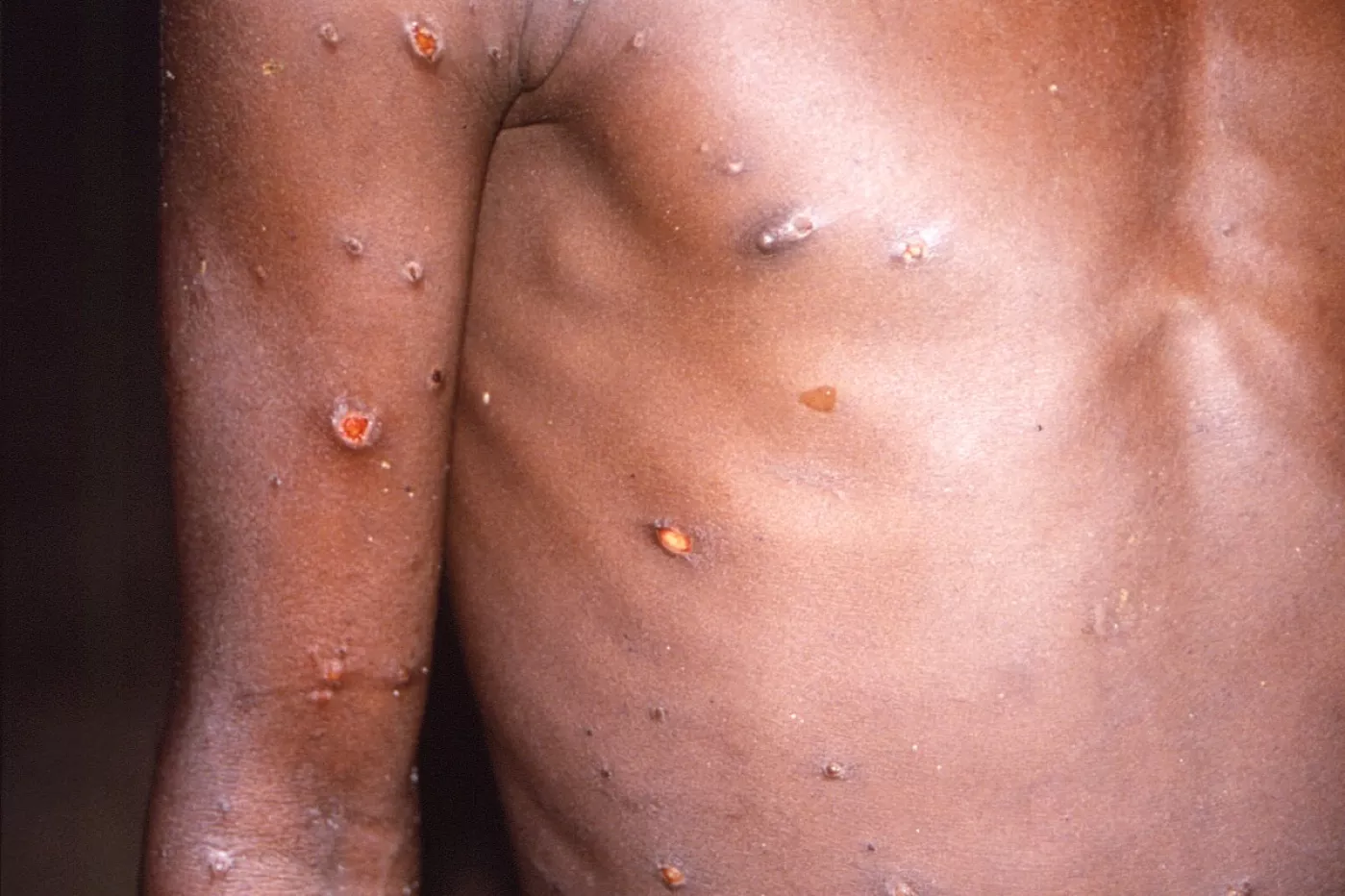 Los casos analizados en el estudio, publicado en 'The Lancet Infectious Diseases', representan los primeros casos de transmisión intrahospitalaria y transmisión domiciliaria fuera de África.