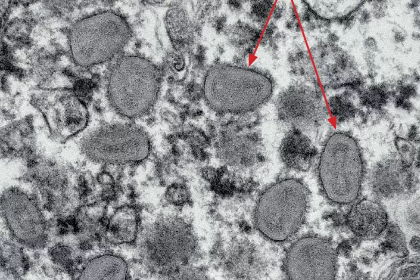 Micrografía electrónica de partículas víricas similares a la viruela de un caso de viruela del mono importado a Australia desde Europa.