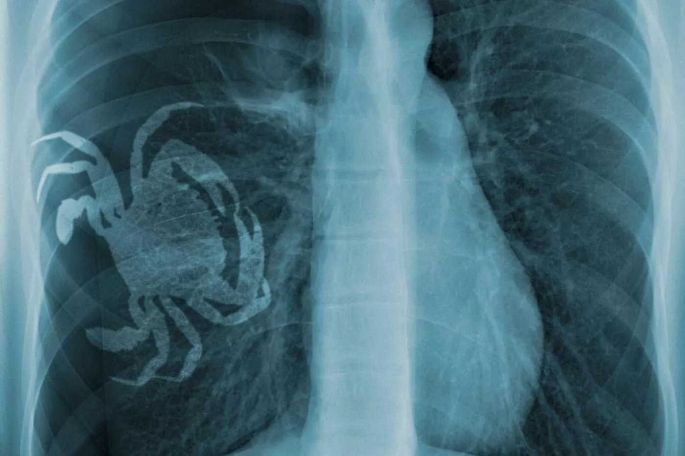 El tumor pulmonar podría ser susceptible de cribado en grupos seleccionados. Foto: DM. 