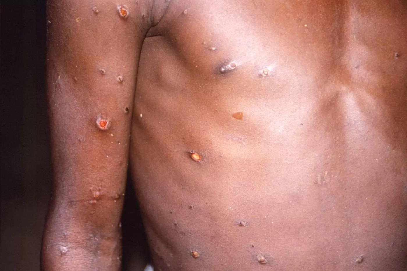 Pústulas que aparecen en la piel del paciente con viruela del mono. Foto: EFE. 