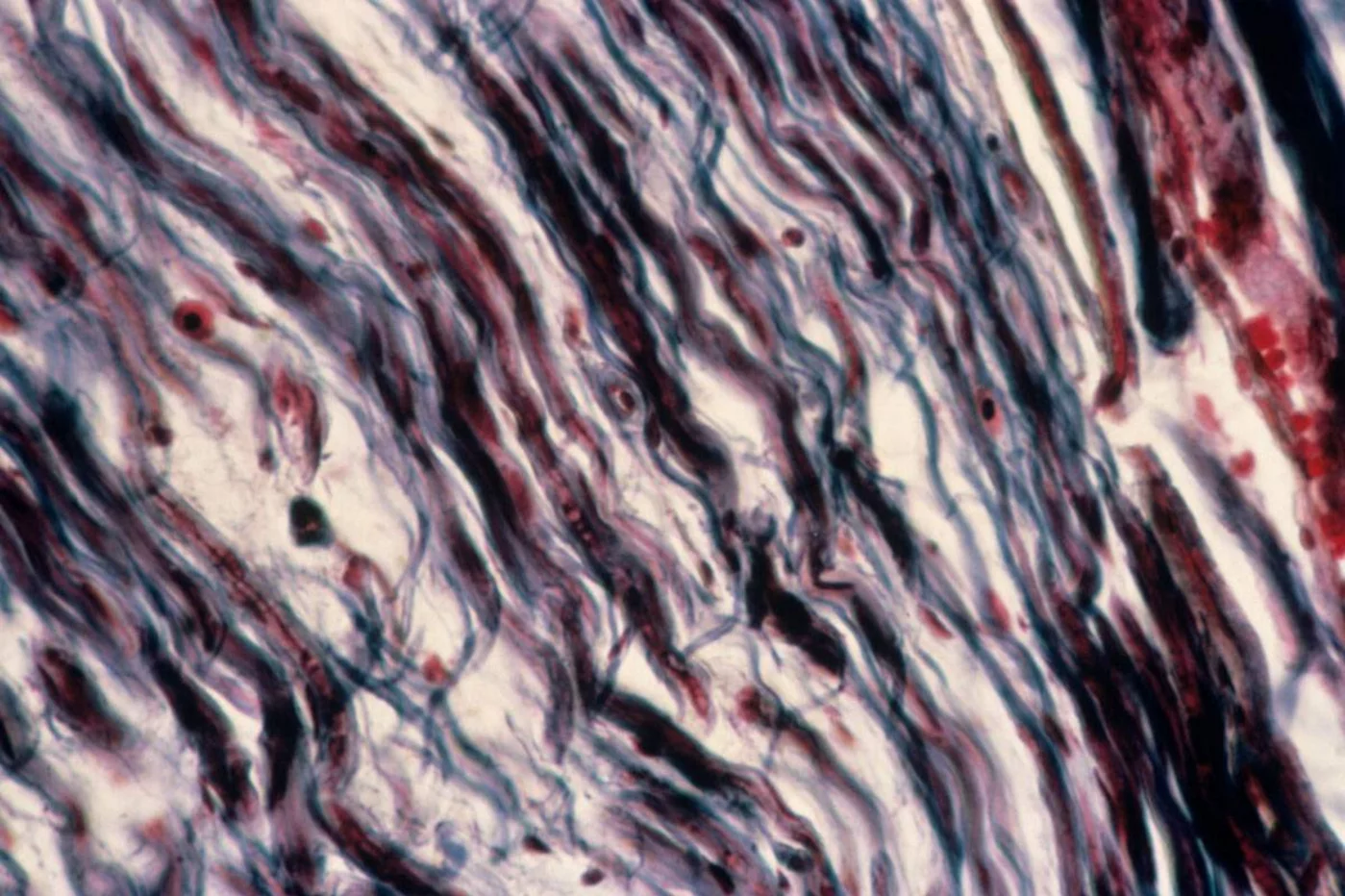 Micrografía de luz de fibras nerviosas que muestran la desmielinización debida a la esclerosis múltiple. Foto: AGEFOTOSTOCK
