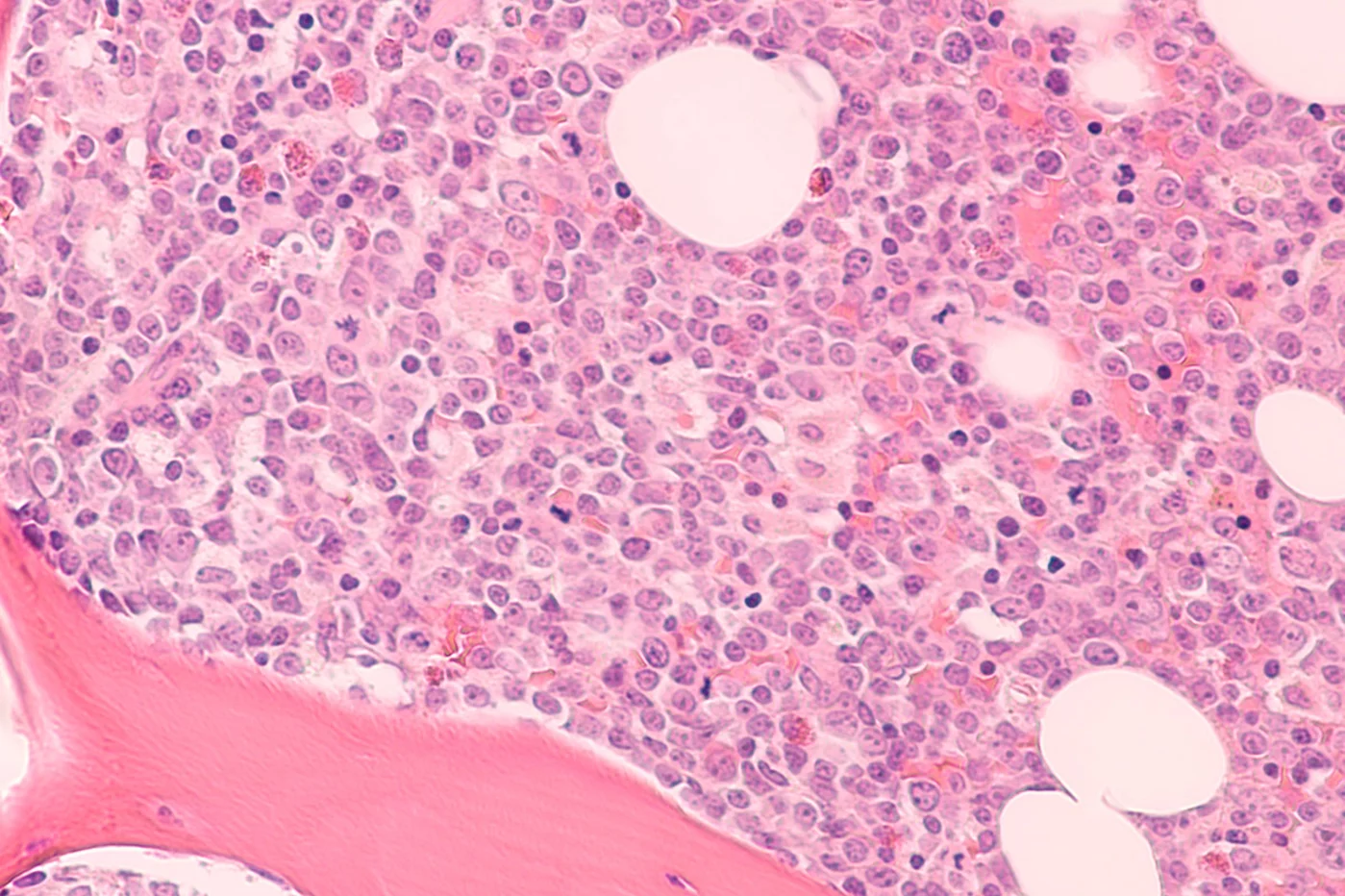 La leucemia mieloide aguda suele presentarse a partir de los 65 años de edad. Foto: DM. 
