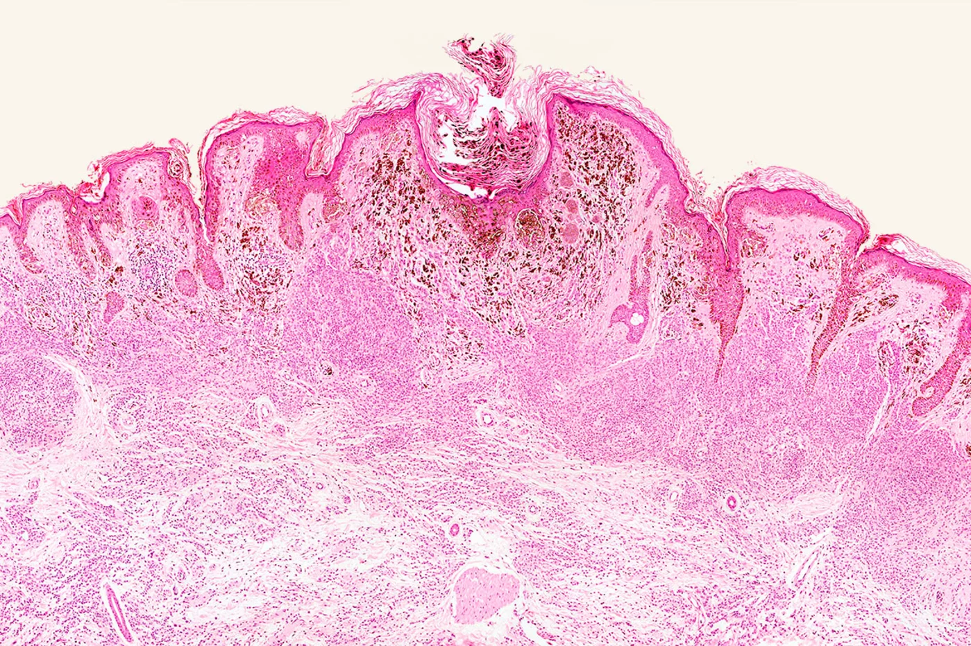 Imagen del microscopio de melanoma maligno.