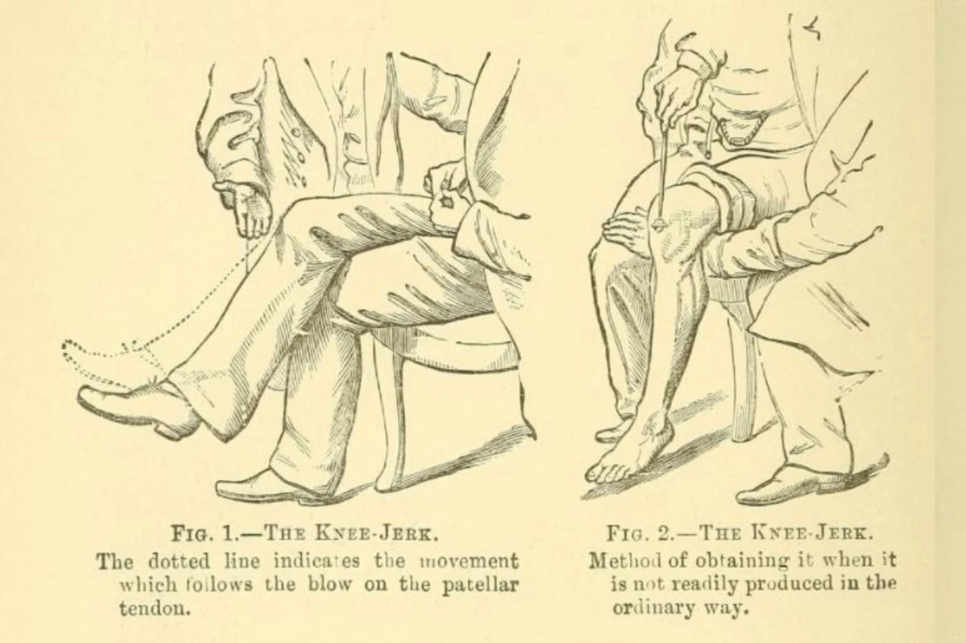 Reflejo rotuliano: al percutir el tendón rotuliano, se contrae el músculo cuádriceps y se produce la extensión de la rodilla.