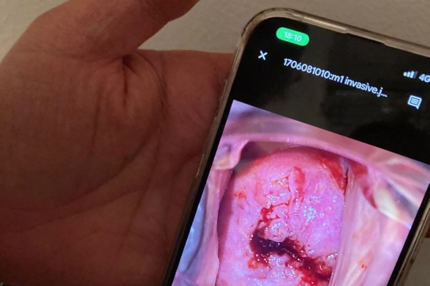 Imagen del cuello uterino de una paciente tratada con ácido acético tomada con un 'smartphone' por un profesional sanitario no especializado y enviada al experto para su evaluación. Foto: CUN. 
