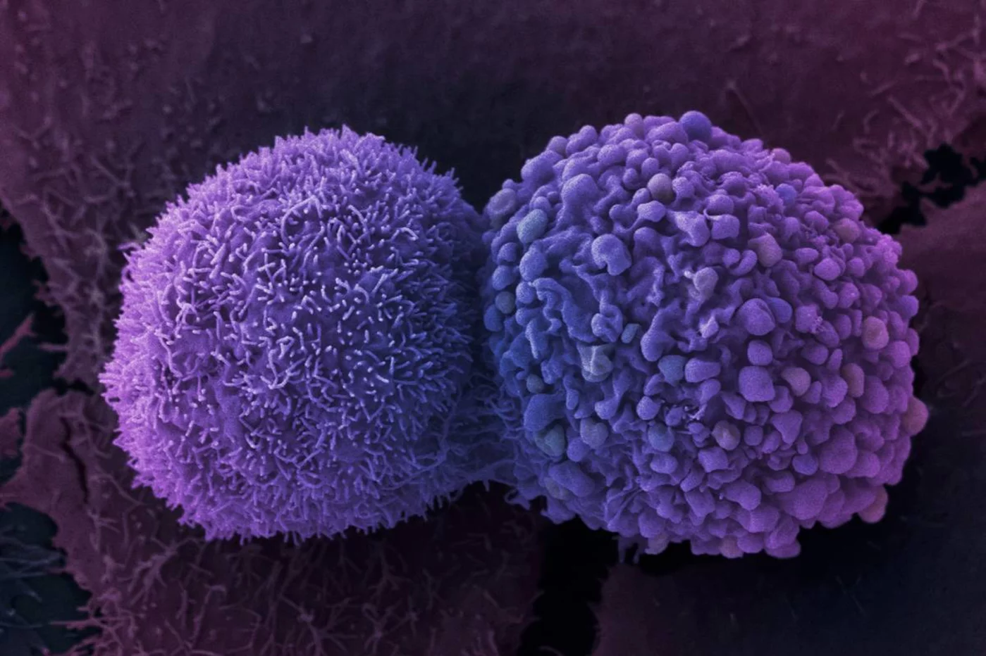 Cuando el cáncer de pulmón se diagnostica en fase tardía, las células tumorales suelen estar diseminadas. Foto: DM. 
