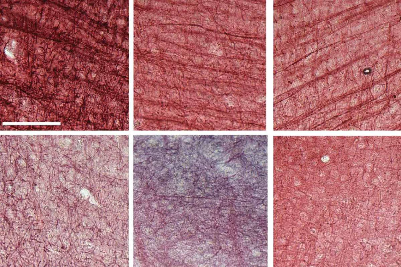 Muestras de tejido cerebral postmortem de tres individuos revela menos mielinización en aquellos con una copia del gen ‘APOE4’ (fila inferior). Foto: MIT.