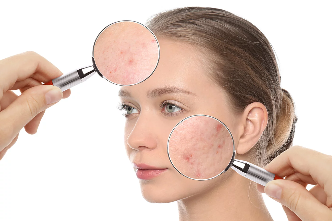 La importancia de los retinoides tópicos en el tratamiento del acné