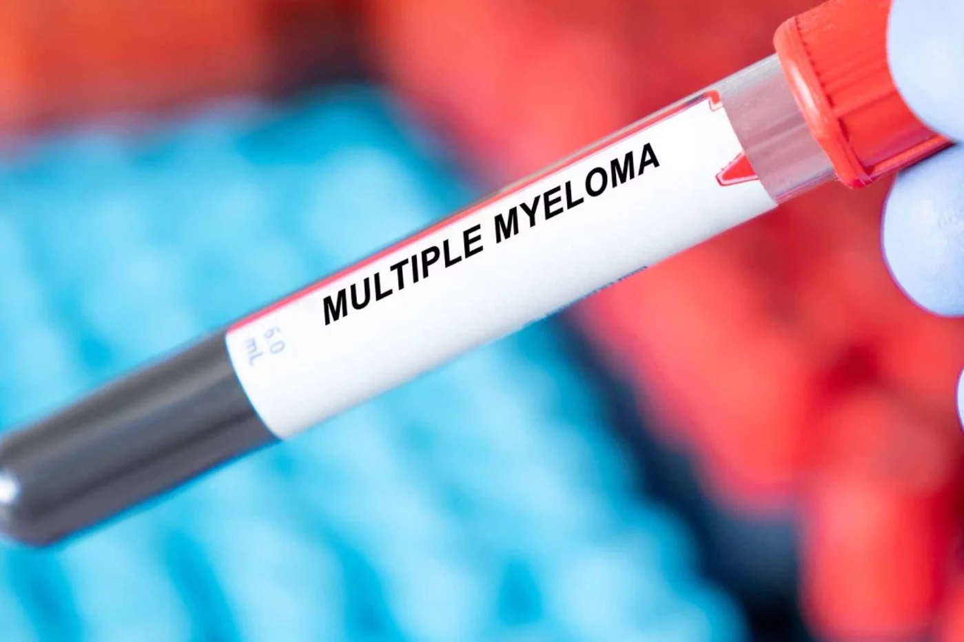 El mieloma múltiple es una de las enfermedades raras de mayor incidencia.