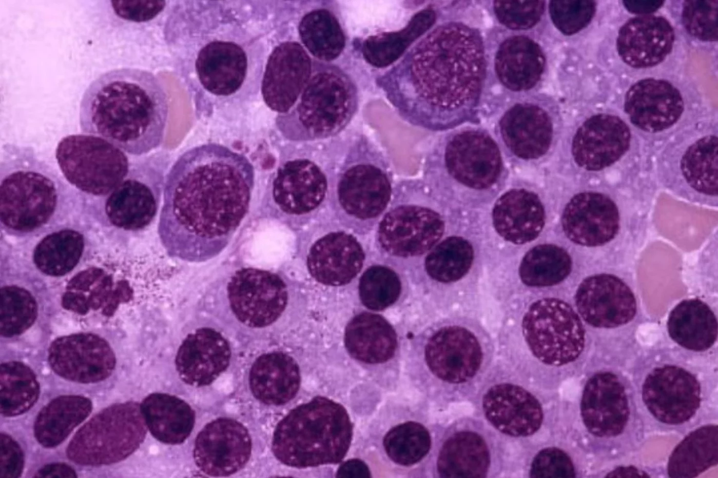 La macroglobulinemia de Waldenström representa el 2% de los cánceres hematológicos. Foto: DM. 