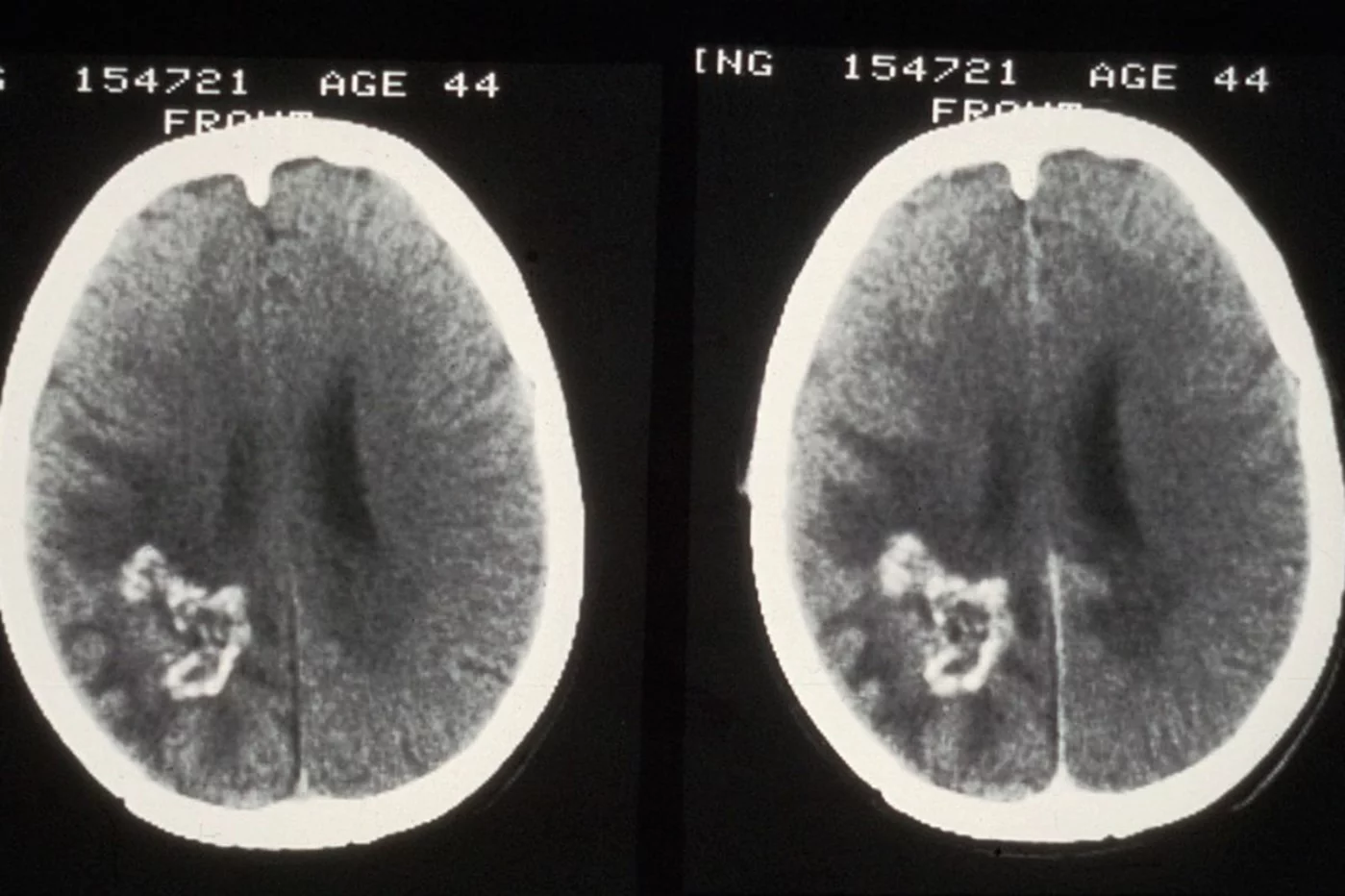 El glioblastoma es uno de los cánceres cerebrales de elevada letalidad. Foto: DM. 