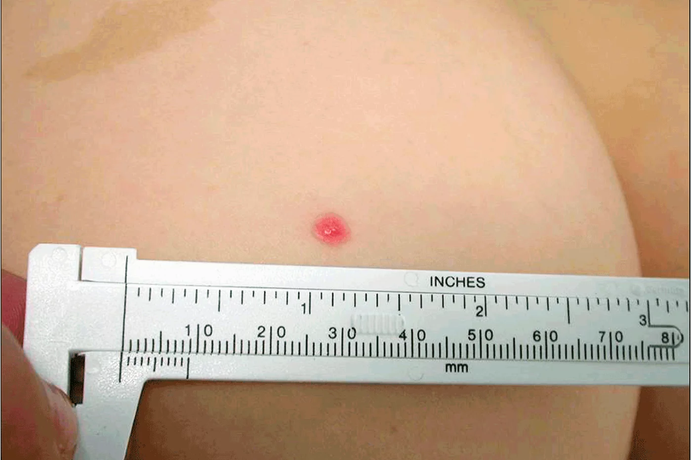 Una lesión rosada puede indicar melanoma infantil, que difiere a menudo del del adulto. Foto: IDIBAPS