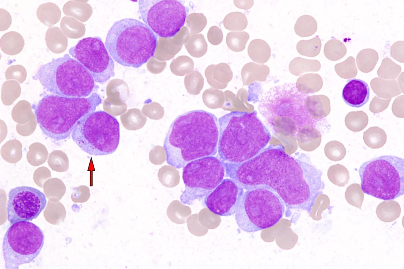 Leucemia mieloide aguda. Imagen: ATLAS OF HAEMATOLOGICAL CYTOLOGY.