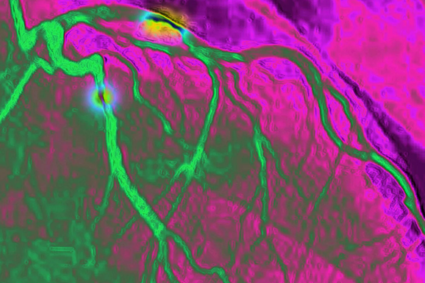 Visualización por angiografía de un infarto de miocardio por destrucción parcial del músculo cardiaco debido a dos estenosis en la arteria coronaria izquierda. Foto: AGEFOTOSTOCK
